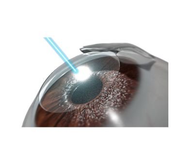 Best Lasik Eye Surgery Doctors in Hyderabad